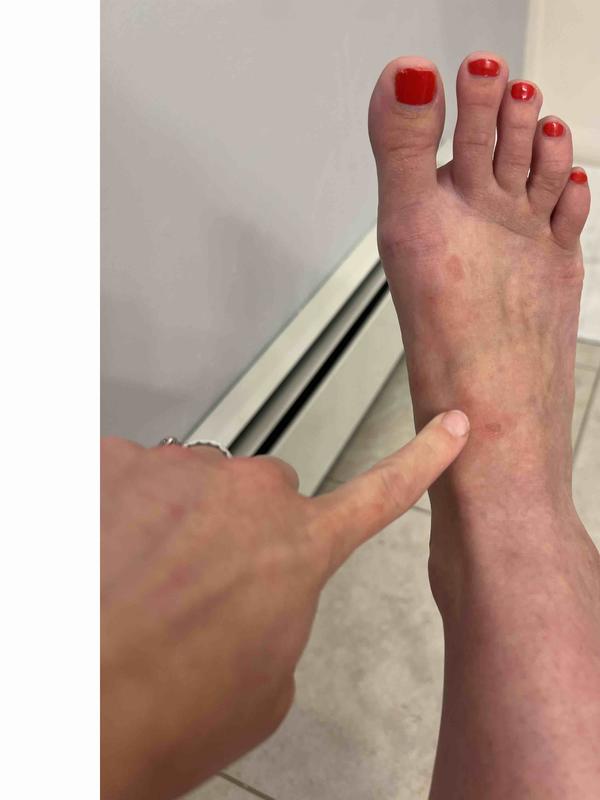 Customer photo for "ouch!! blisters on top of my feet!"