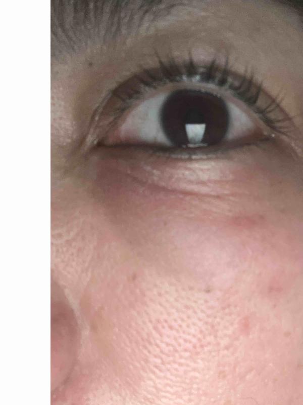 Customer photo for "skin damage/burn"