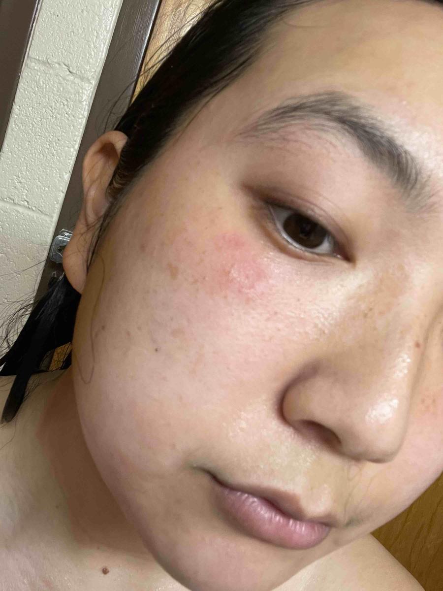 Customer photo for "TERRIBLE for sensitive skin"