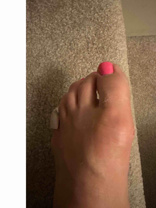 Customer photo for "bunion problems!!! BEWARE"
