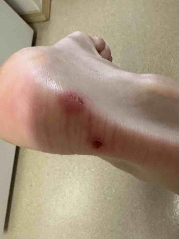 Customer photo for "The WORST blisters"