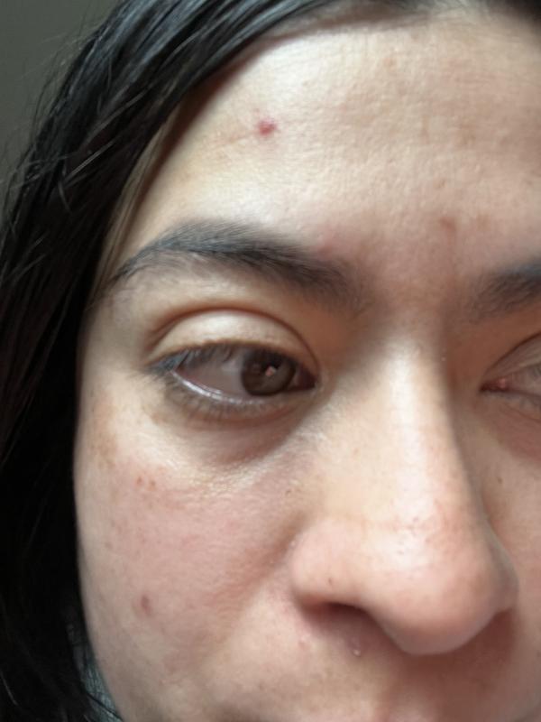 Customer photo for "Helps with inflammation faster"