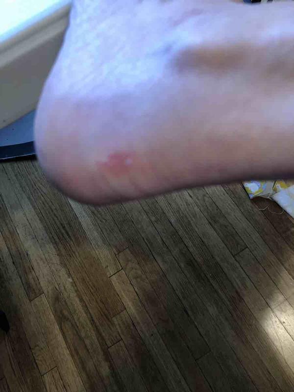 Achilles pull tab design flaw