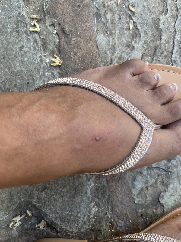 Customer photo for "Scar on foot"