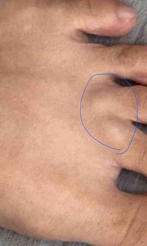 Triggered Mortons Neuroma