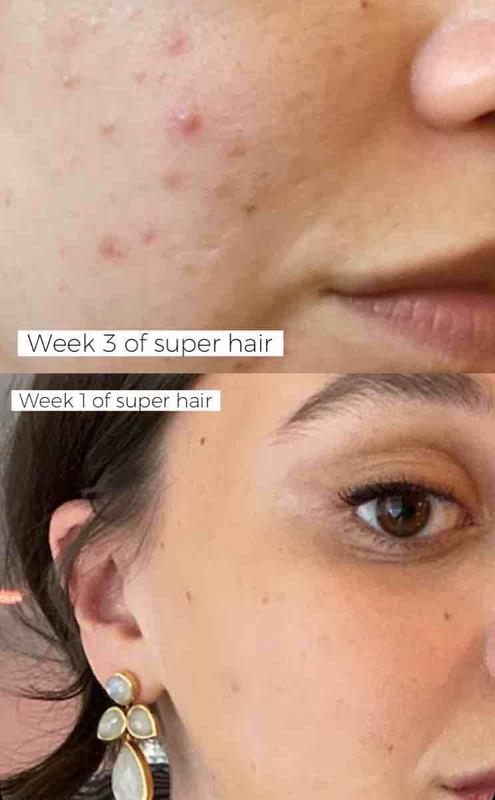 Customer photo for "Grows your hair, causes breakouts"