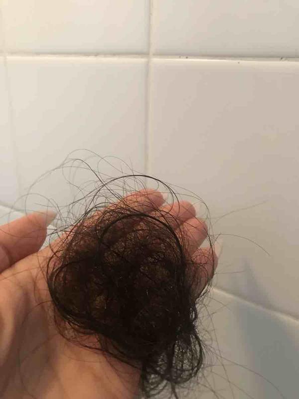 hair loss , itchy scalp
