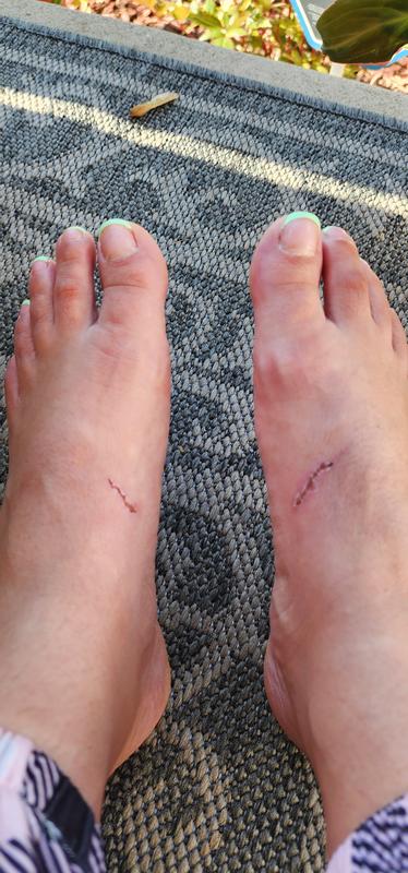 Blisters on both feet