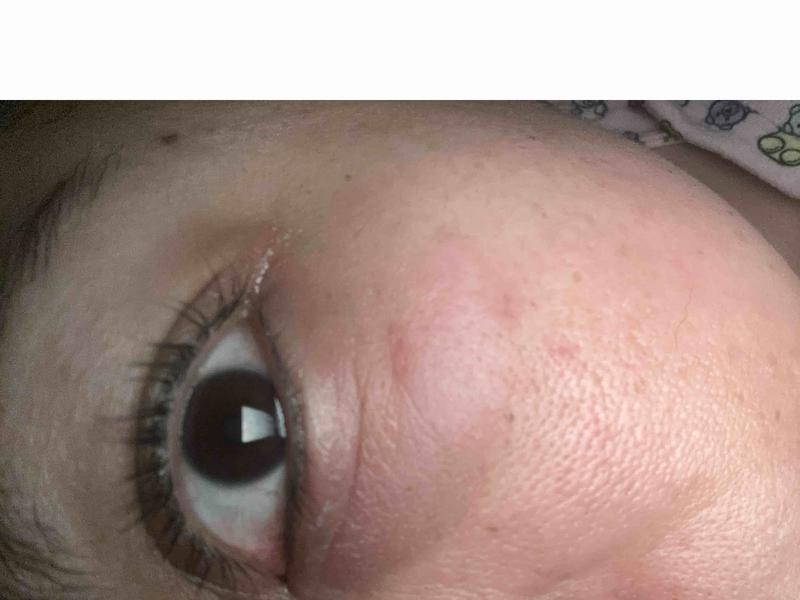 Customer photo for "skin damage/burn"
