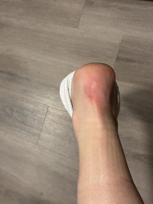 Customer photo for "I could not wear shoes for 1 month"