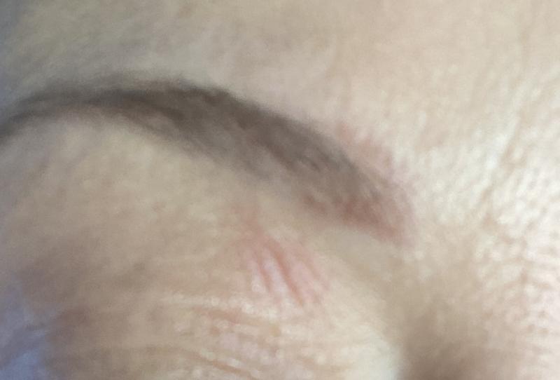 Customer photo for "Eye lids burned"