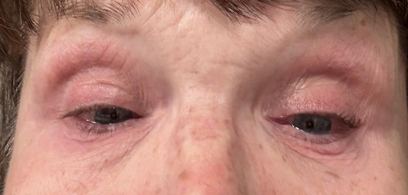 Customer photo for "Eye Rash & Infection — Buyer Beware"