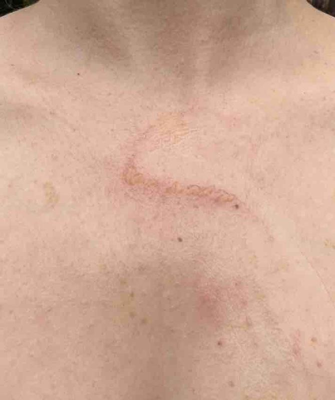 Customer photo for "Gentle flag of possible tension blisters"