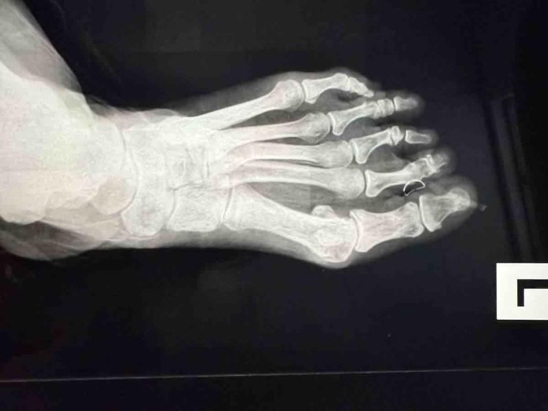 Ignore the one star review from the neuroma lady