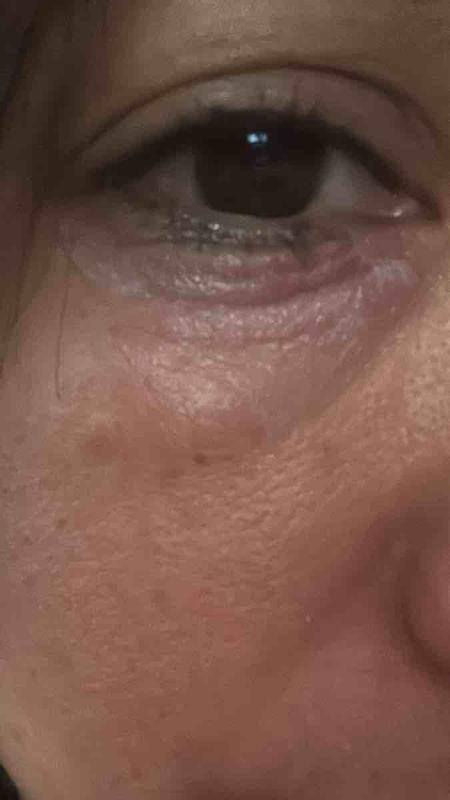 Customer photo for "skin damage/burn"