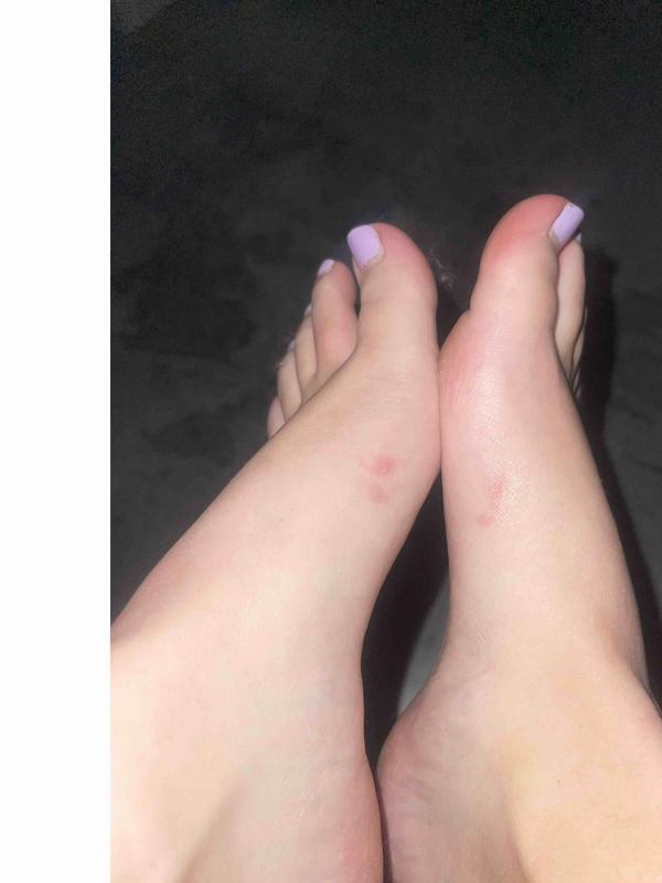 Customer photo for "blisters!"