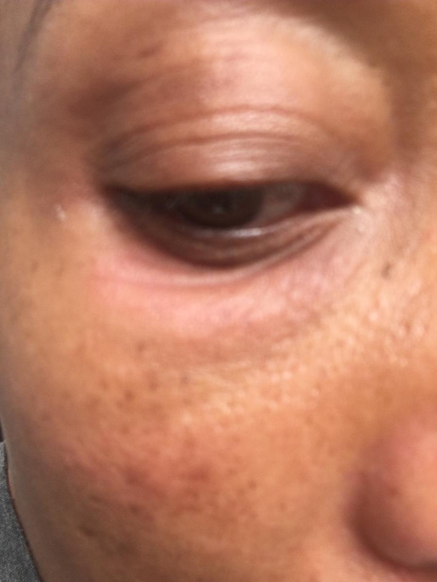 Customer photo for "Bad Reaction"