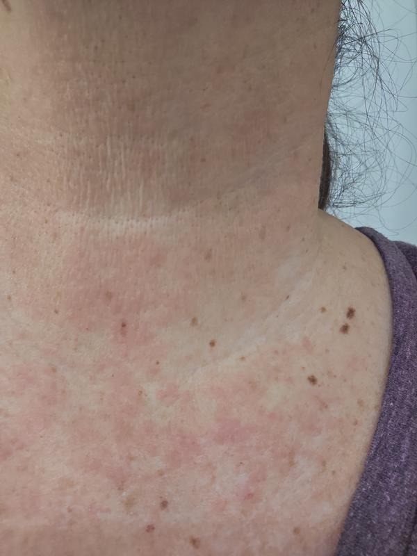 Customer photo for "Irritated Skin"