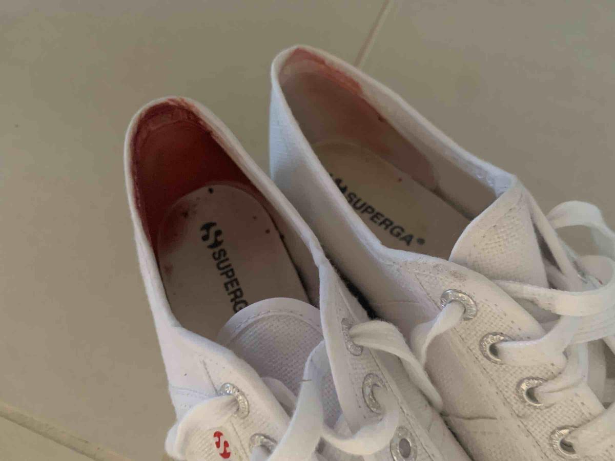 Customer photo for "WORST BLISTERS OF ALL TIME"