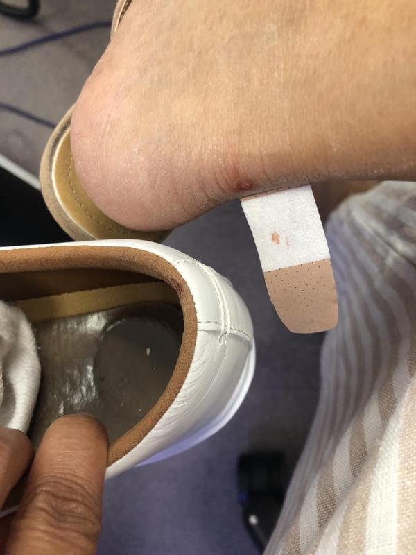 gave me blisters that bled