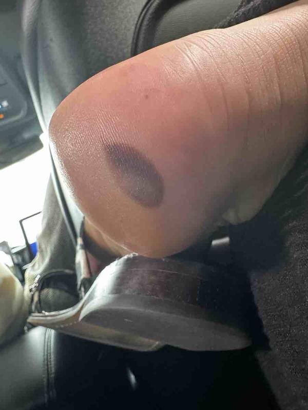 Gave me a blood blister