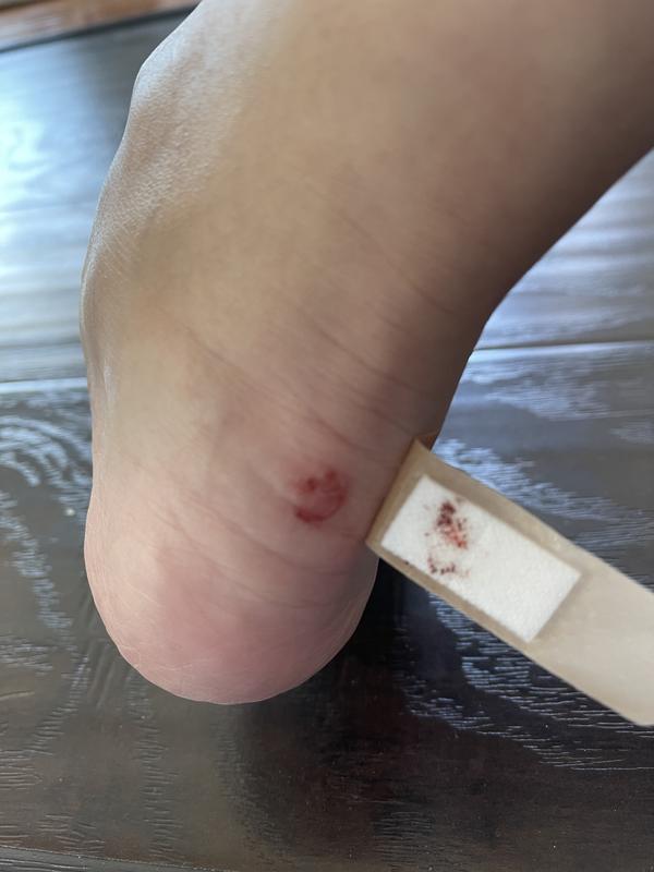 Customer photo for "Blistered feet"