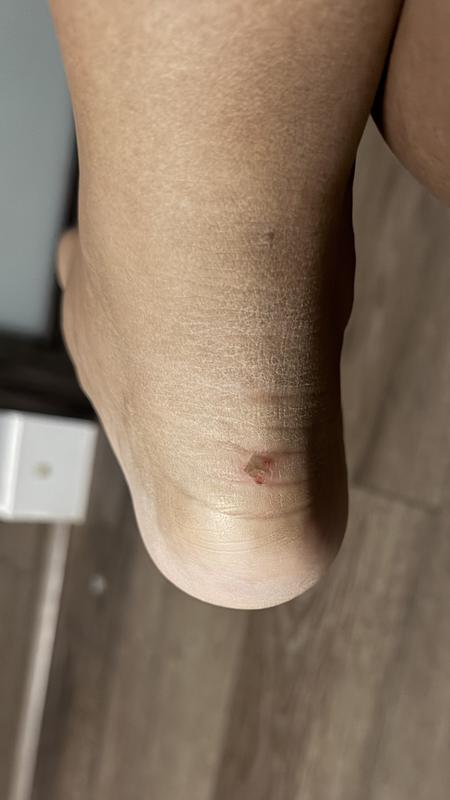 heel cuts and abrasions