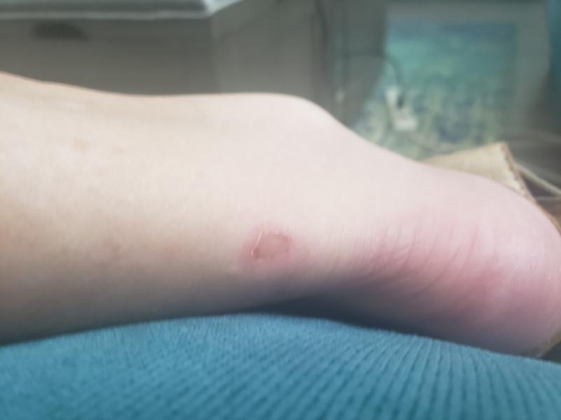 Blister on ankle