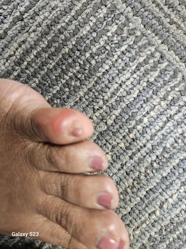 Right and left pinky toe