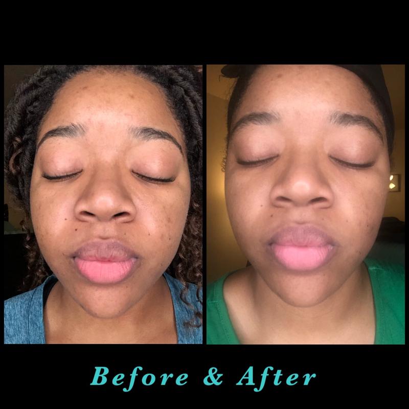 neutrogena dark spot corrector before and after