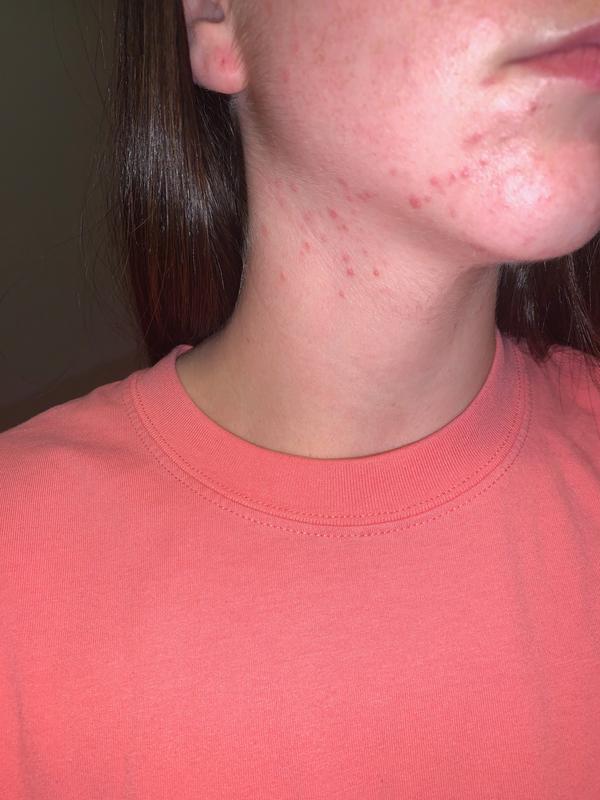 Allergic Reaction To Makeup Remover Wipes Saubhaya Makeup