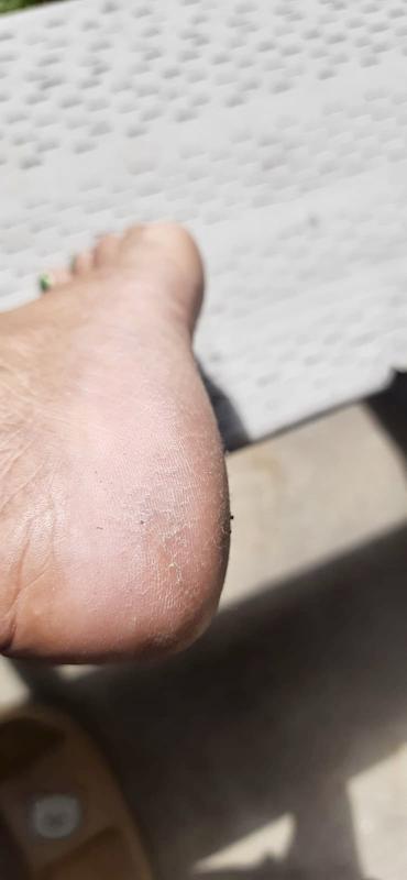 Would a cheese grater effectively scrape off and treat dry skin on cracked  feet as bad as these if you don't have anything else to use? - Quora