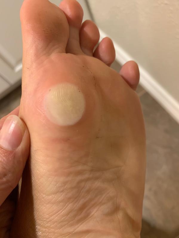 Best Callus Remover. Callus Eliminator, Liquid & Gel For Corn And Callus On  Feet