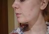 After - new hormonal blemishes but skin looks clearer