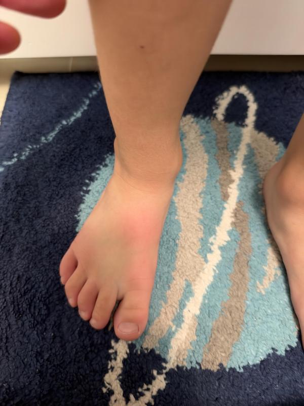 Right foot after both shoes and socks were removed.