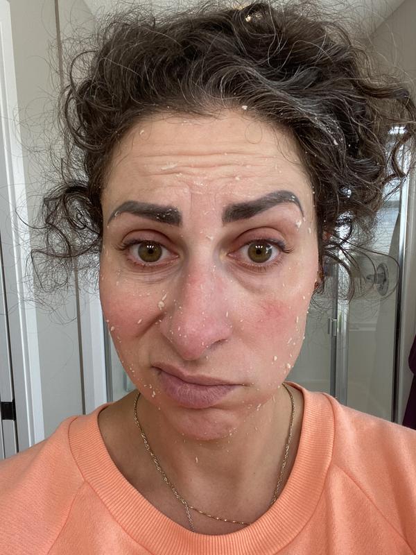 Pilled mask falling off my face in clumps.