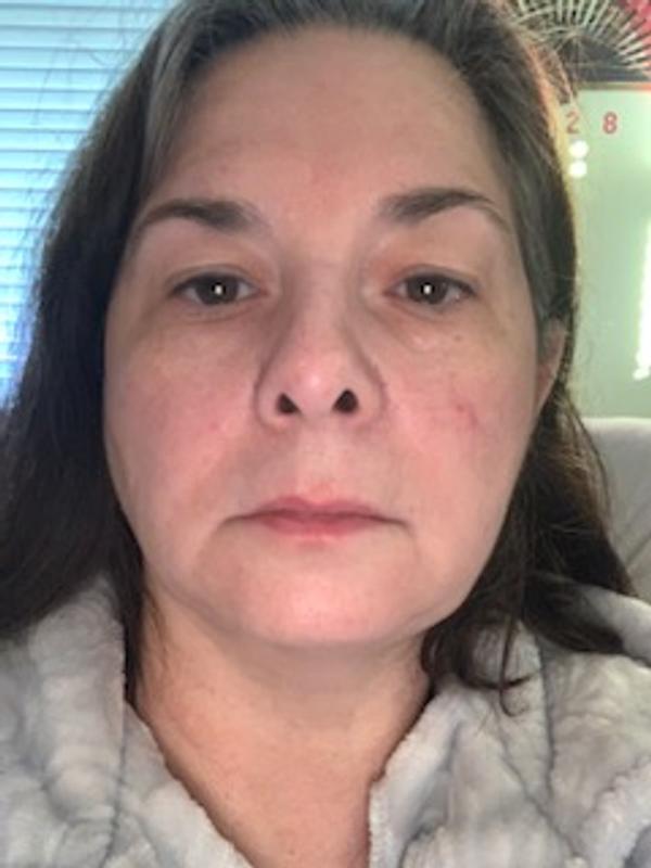 after 1 week - no retouching!