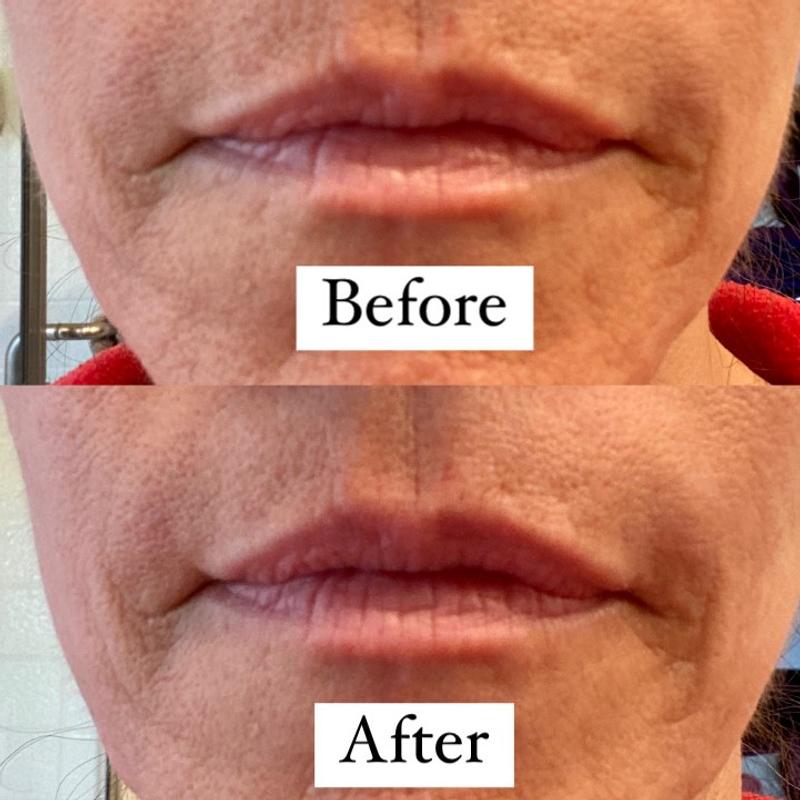 FIX "Lip flick" technique