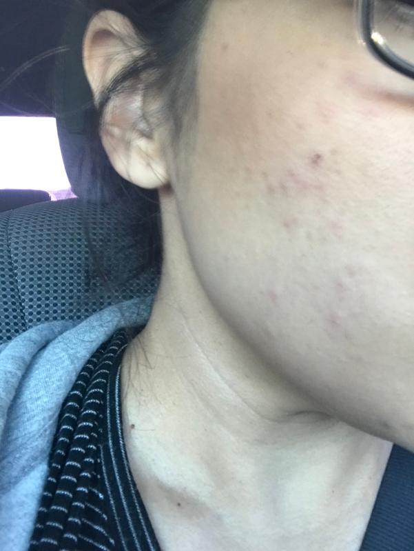 I woke up with this on my cheek and cheek bones on other side