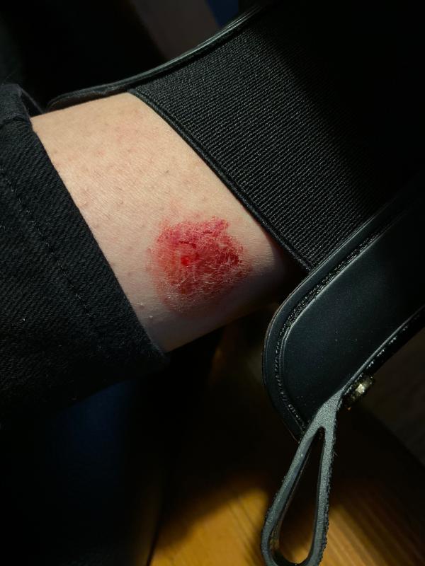 A cut from the shoe.