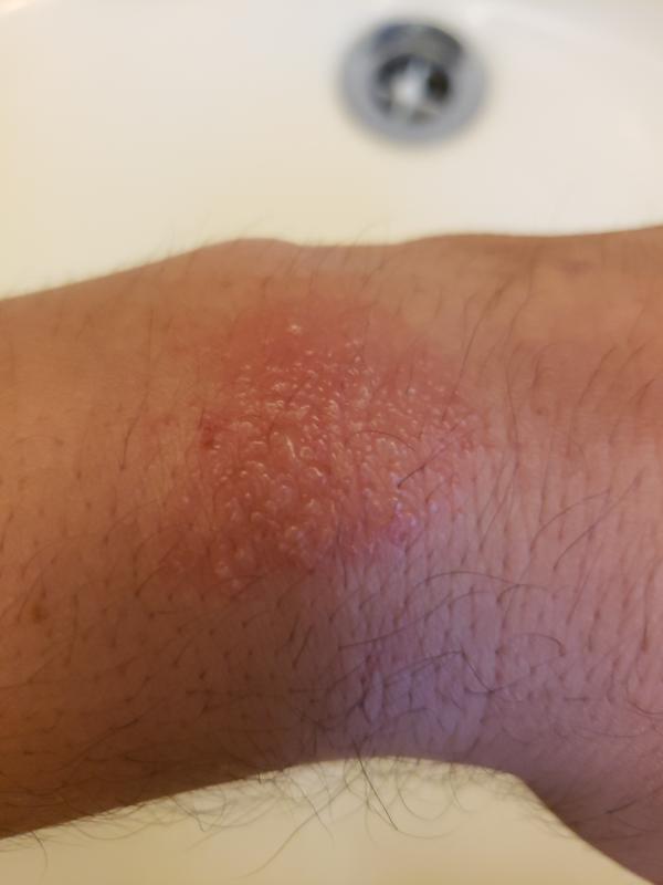 Burn from overheating overnight