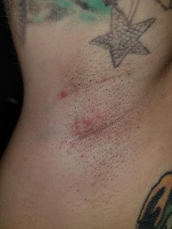 Rash i broke out with