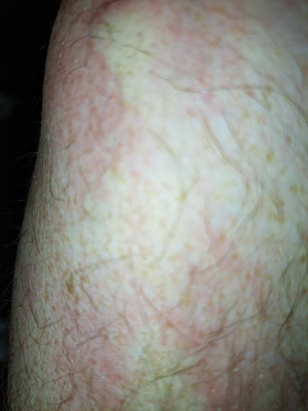 Bites. Won't let me take a picture of the traps with nothing