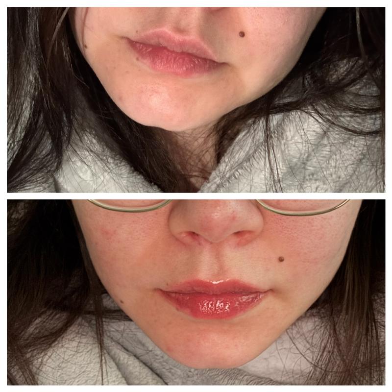 lipo c injection before and after stomach Meet my new fav lip product: the @drdennisgross Plump + Repair Lip Treatment  Tint is coming in February 2026 and it will forever change the way we do  lips! It visibly plumps main image 0