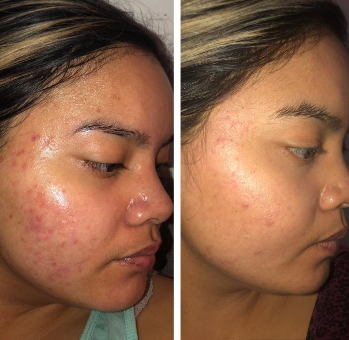 dr dennis gross dark spot serum