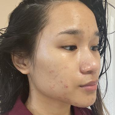 5 Benzoyl Peroxide Acne Spot Treatment Dr Zenovia Skincare Sephora