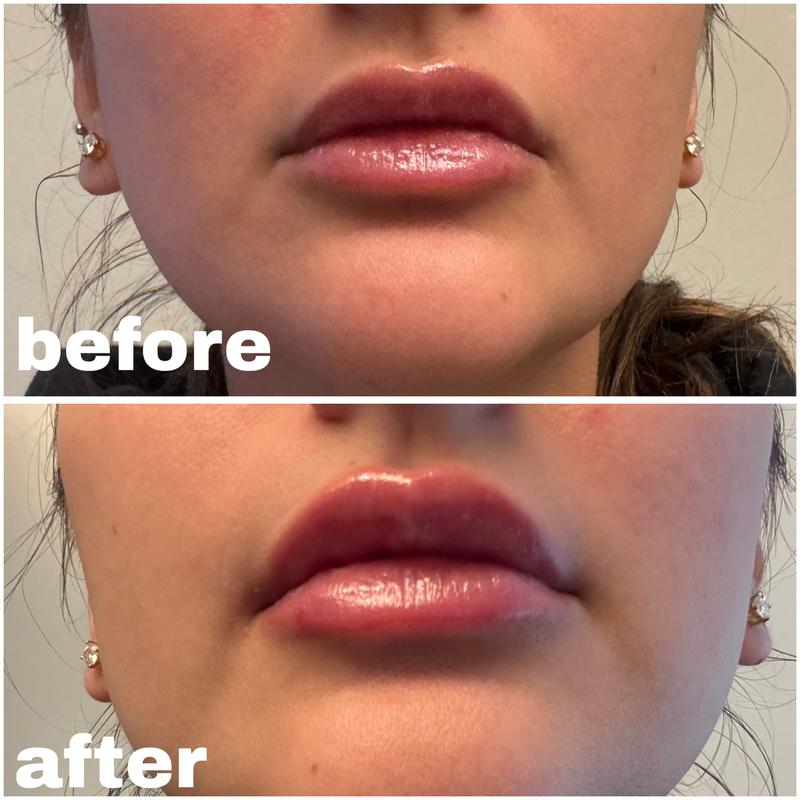 lipo c injection before and after stomach All I Want' GLOSSYBOX: Dr. Dennis Gross Skincare And Nude by Nature