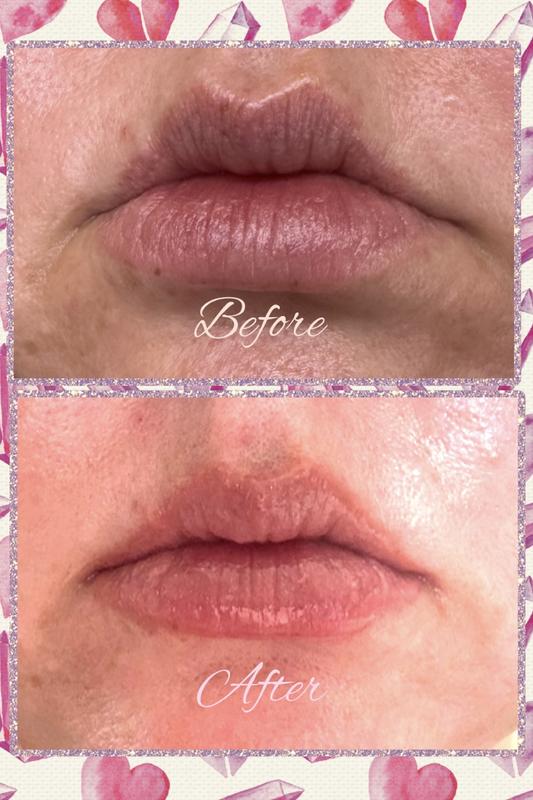 DermInfusions™ Plump + Repair Tinted Lip Treatment with Hyaluronic  Acid - Dr. Dennis Gross Ski