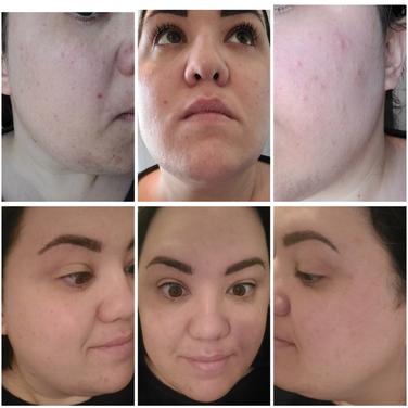 dr brandt microdermabrasion sephora
