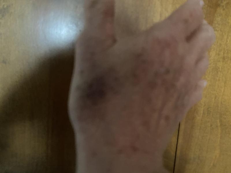 Brusing